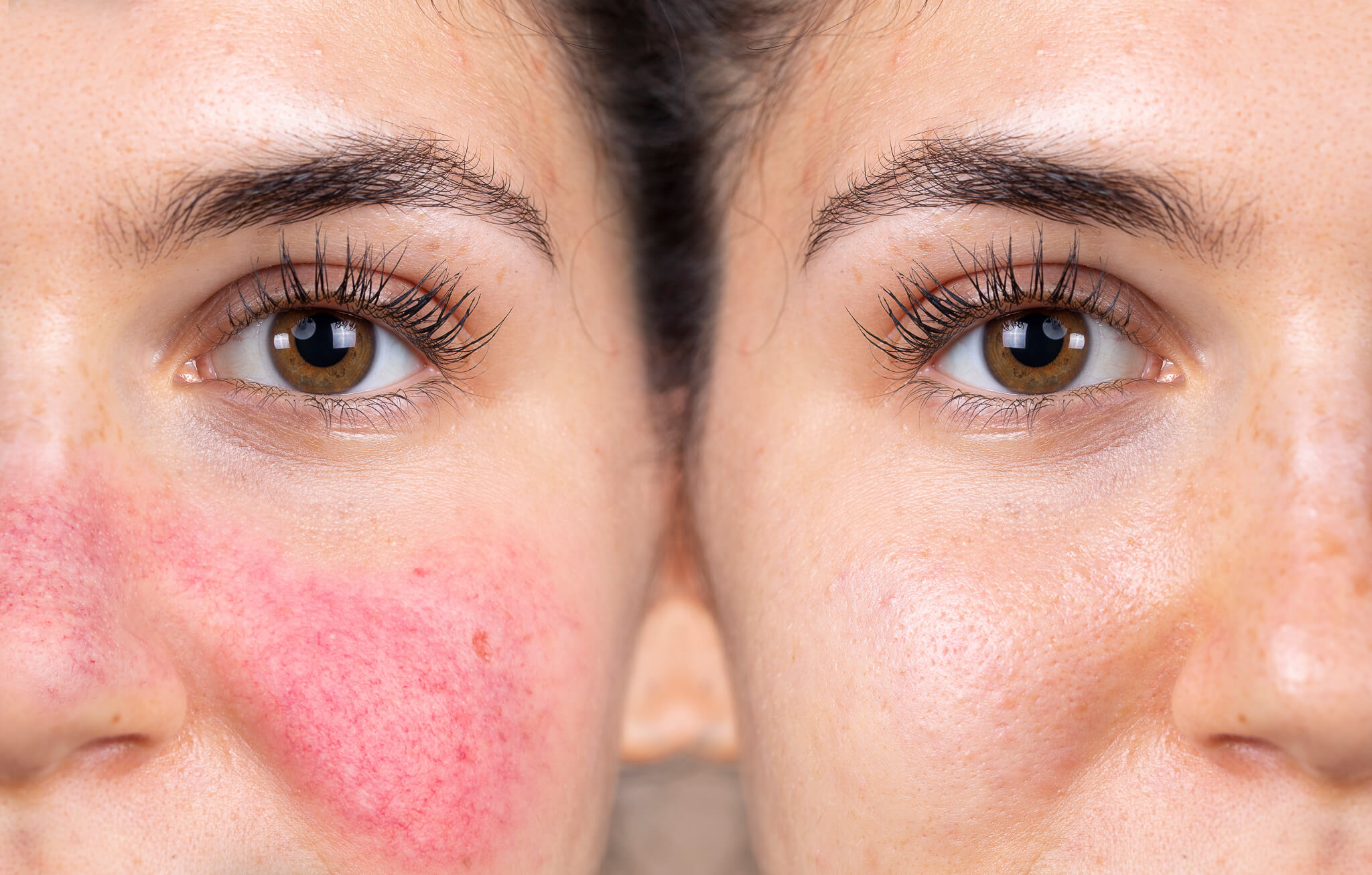 rosacea--priciny--liecba-a-prirodzene-riesenia-2